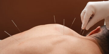 Health Buzz: Theories of acupuncture  