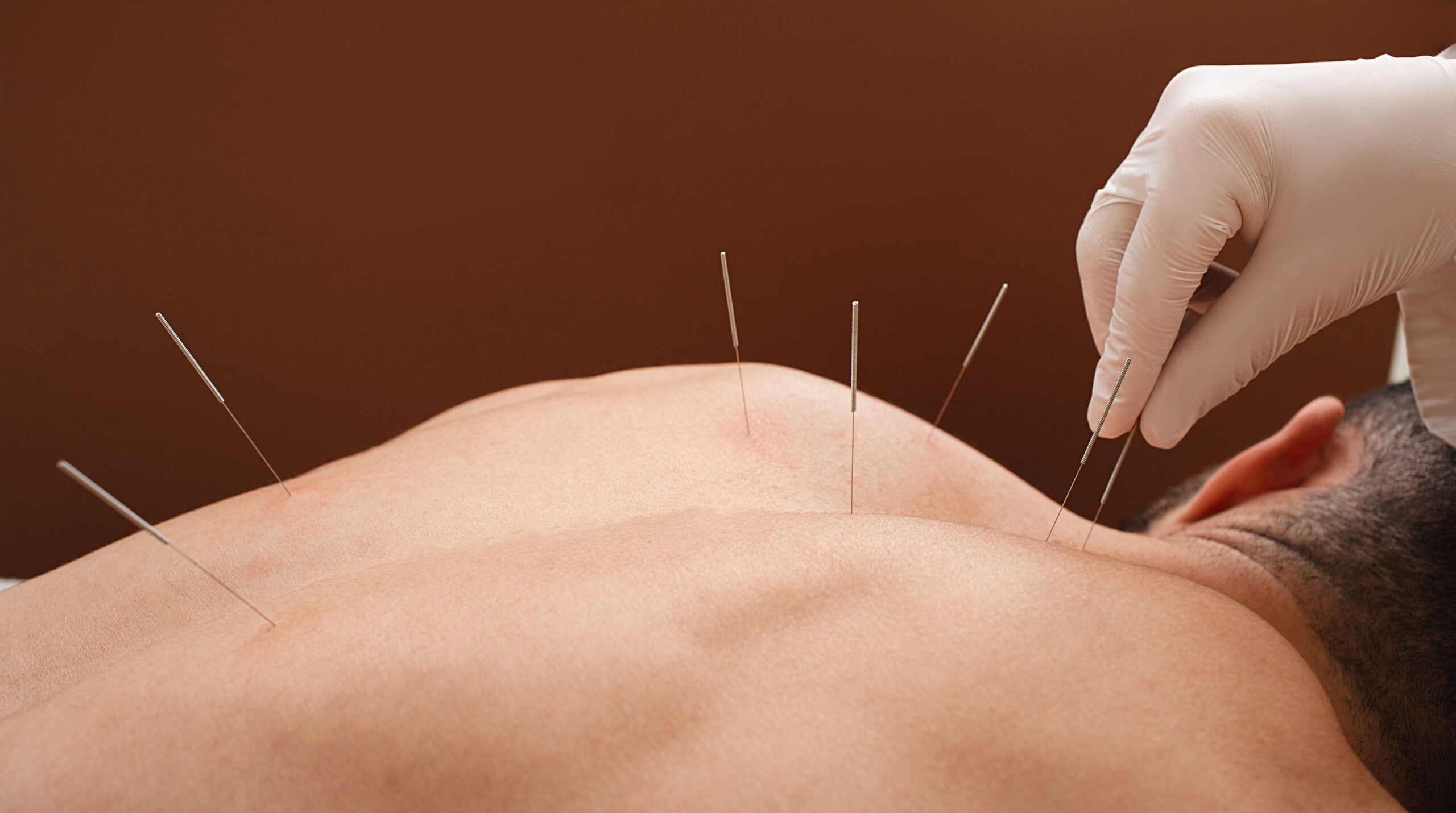 Health Buzz: Theories of acupuncture  